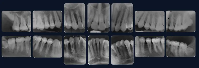 Serie periapical completa: 14 radiografías de los dientes superiores e inferiores